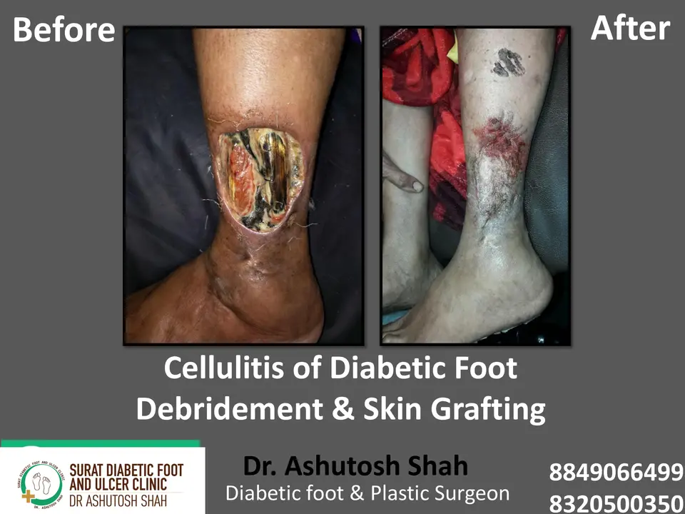 Diabetic Cellulitis and Coverage.pptx-16.webp